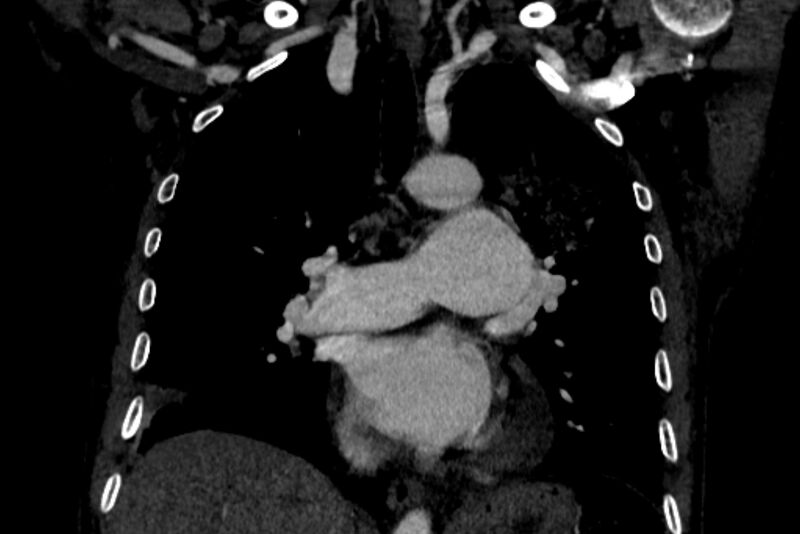 File:Chronic pulmonary embolism with bubbly consolidation (Radiopaedia 91248-108850 B 73).jpg