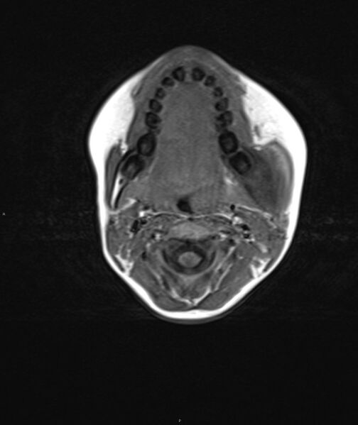 File:Chronic reactive multifocal osteomyelitis (CRMO) - mandible (Radiopaedia 56405-63069 Axial T1 11).jpg