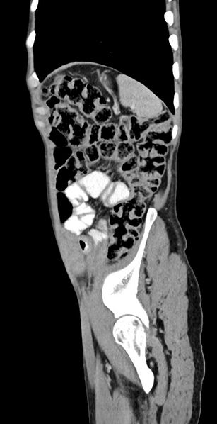 File:Chronic small bowel volvulus (Radiopaedia 75224-86322 C 32).jpg