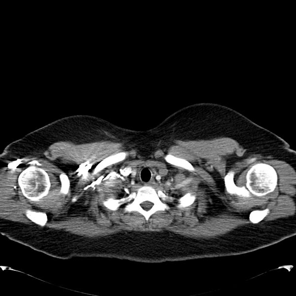 File:Chronic thromboembolic pulmonary hypertension (CTEPH) (Radiopaedia 74597-85531 Axial C+ CTPA 5).jpg