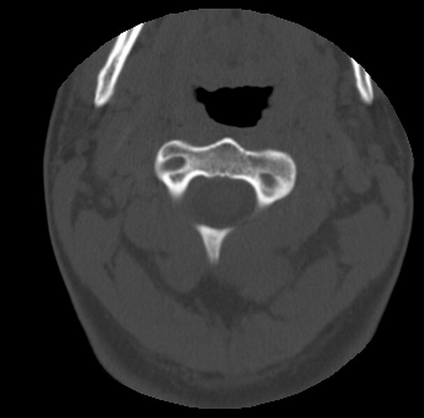 File:Clay-shoveler fracture (Radiopaedia 22568-22590 Axial bone window 17).jpg