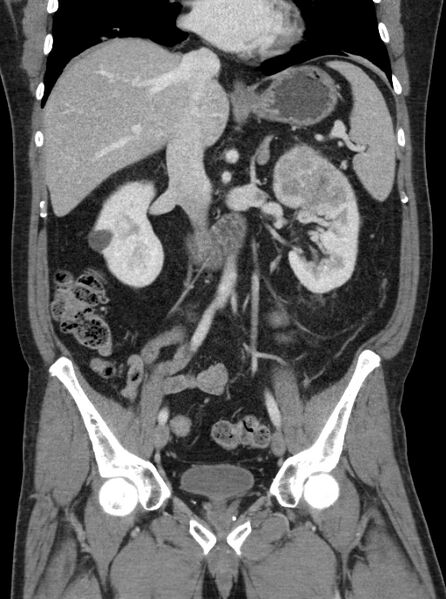 File:Clear cell renal cell carcinoma (Radiopaedia 61449-69393 F 16).jpg
