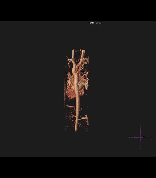 File:Coarctation of the aorta (Radiopaedia 43373-46729 3D reconstruction 8).jpg