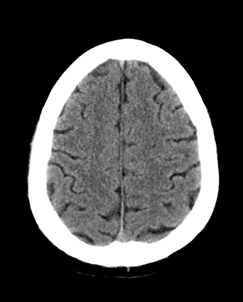 File:Colloid cyst of the third ventricle (Radiopaedia 86571-102661 Axial non-contrast 26).png