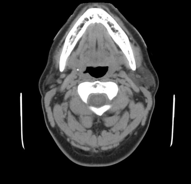 File:Colloid cyst of thyroid (Radiopaedia 22897-22923 Axial non-contrast 18).jpg