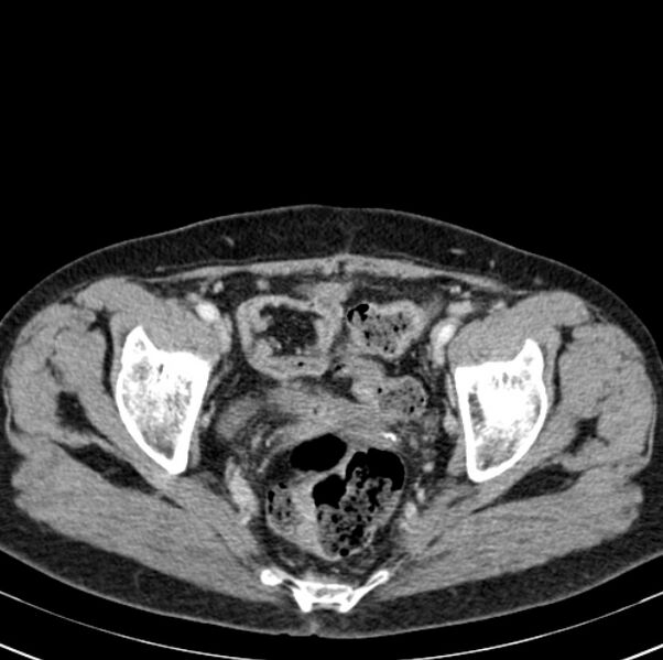 File:Colon carcinoma with hepatic metastases (Radiopaedia 29477-29961 A 102).jpg