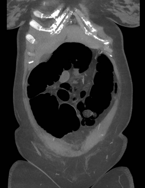File:Colonic pseudo-obstruction (Radiopaedia 79752-92980 B 19).png