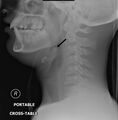 Epiglottitis in adult (Radiopaedia 22906).jpg