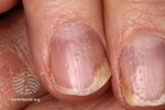Nail pitting due to psoriatic nail dystrophy. (DermNet NZ psorkynsi3).jpg