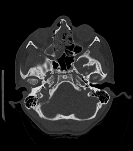 File:Nasoorbitoethmoid fracture (Radiopaedia 90044-107205 Axial bone window 74).jpg