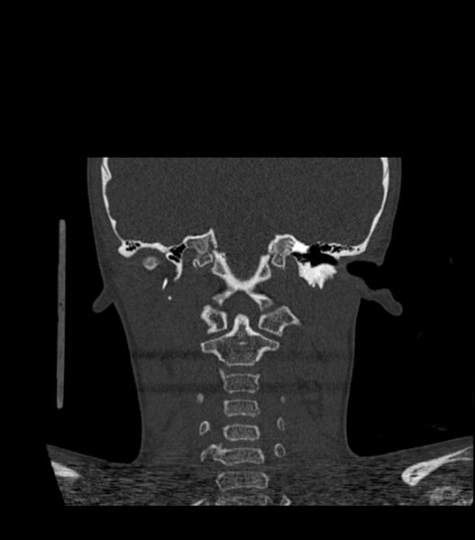 File:Nasoorbitoethmoid fracture (Radiopaedia 90044-107205 Coronal bone window 98).jpg