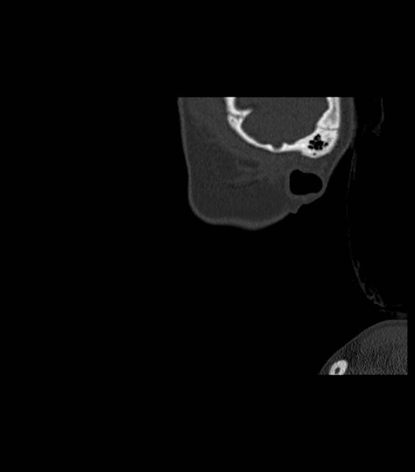 Nasoorbitoethmoid fracture (Radiopaedia 90044-107205 Sagittal bone window 133).jpg