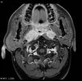 Nasopharyngeal carcinoma (Radiopaedia 4546-6667 Axial T1 C+ fat sat 12).jpg