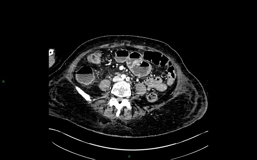Neo-terminal ileal stricture (Crohn disease) (Radiopaedia 33790-34948 A 269).jpg