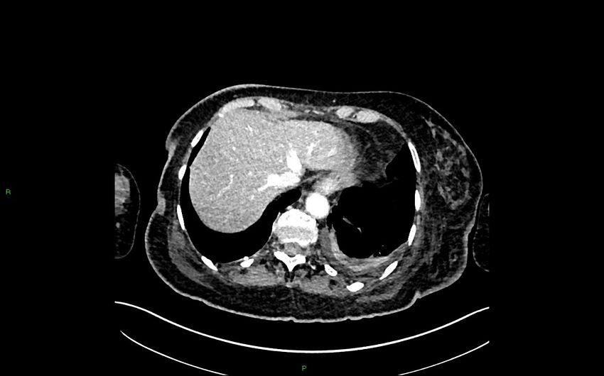 Neo-terminal ileal stricture (Crohn disease) (Radiopaedia 33790-34948 A 50).jpg