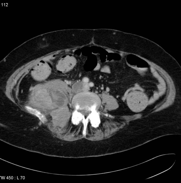File:Nerve sheath tumor - malignant - sacrum (Radiopaedia 5219-6987 A 2).jpg