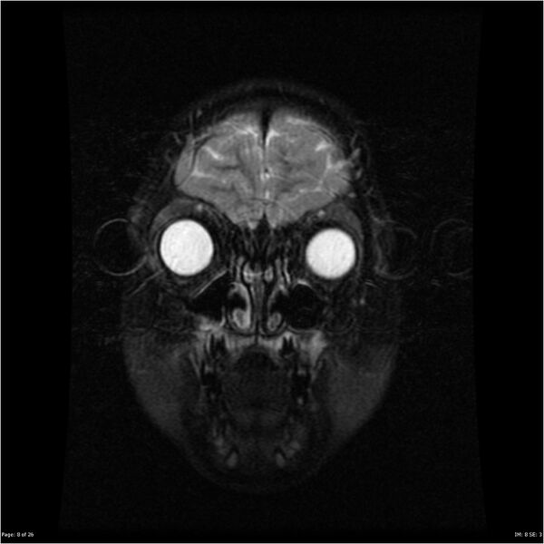 File:Neurofibromatosis type 1 (Radiopaedia 22541-22564 C 8).jpg