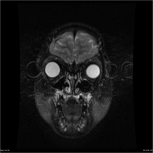 File:Neurofibromatosis type 1 (Radiopaedia 22541-22564 Coronal T1 17).jpg