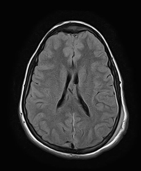 File:Neurofibromatosis type 2 (Radiopaedia 66211-75401 Axial FLAIR 19).jpg