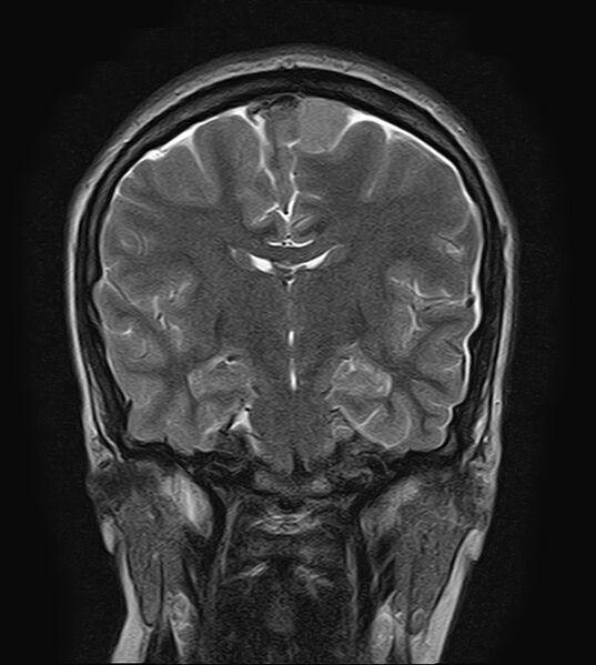 File:Neurofibromatosis type 2 (Radiopaedia 66211-75401 Coronal T2 12).jpg