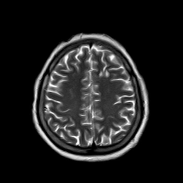 File:Neurofibromatosis type 2 (Radiopaedia 67470-76871 Axial T2 18).jpg
