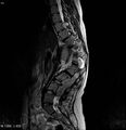 Neurofibromatosis type 2 - cranial and spinal involvement (Radiopaedia 5351-7112 B 11).jpg