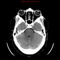 Neuroglial cyst (Radiopaedia 10713-11185 Axial non-contrast 23).jpg