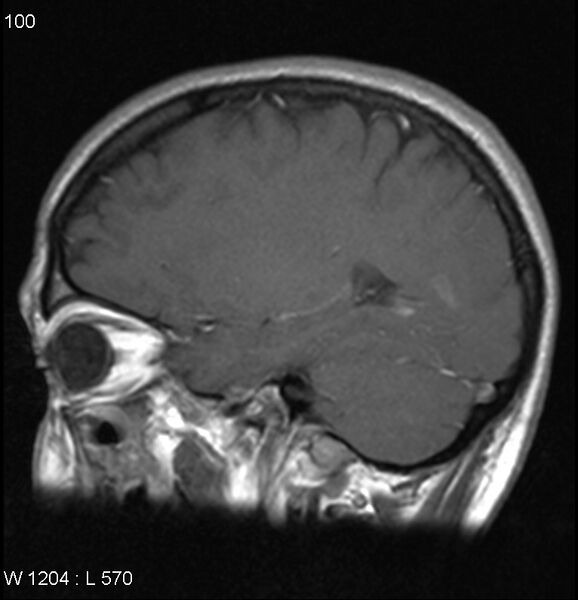 File:Neurosarcoidosis (Radiopaedia 10930-17204 Sagittal T1 C+ 5).jpg
