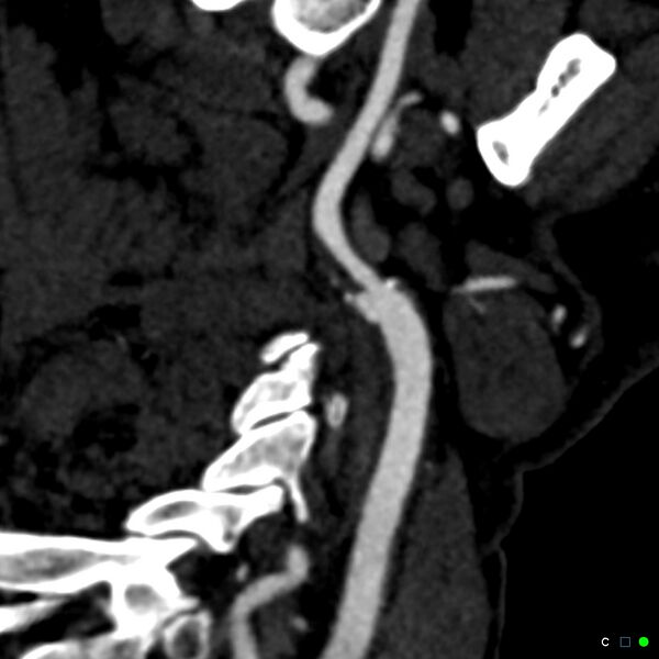 File:Non-occlusive intraluminal internal carotid artery thrombus (Radiopaedia 37751-39658 C 15).jpg