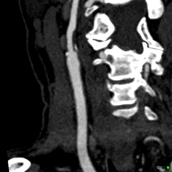 File:Non-occlusive intraluminal internal carotid artery thrombus (Radiopaedia 37751-39658 C 39).jpg