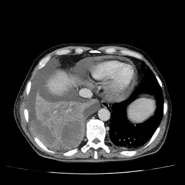 File:Non small-cell lung cancer (Radiopaedia 24467-24769 C+ delayed 49).jpg