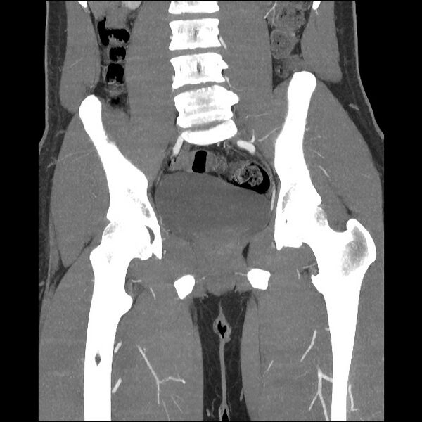 File:Normal CT angiogram of pelvis (Radiopaedia 45390-49430 B 27).jpg