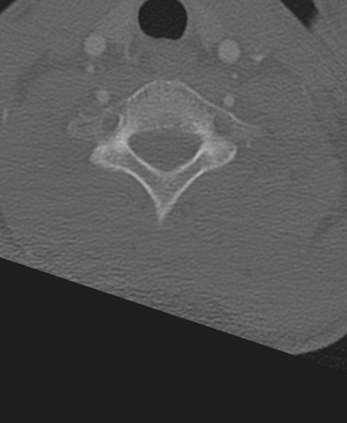 File:Normal CT thoracic spine (Radiopaedia 40181-42688 Axial bone window 5).png