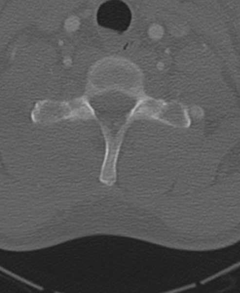 File:Normal CT thoracic spine (Radiopaedia 40181-42688 Axial bone window 8).png