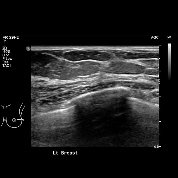 File:Normal breast mammography (tomosynthesis) and ultrasound (Radiopaedia 65325-74354 Left breast 4).jpeg