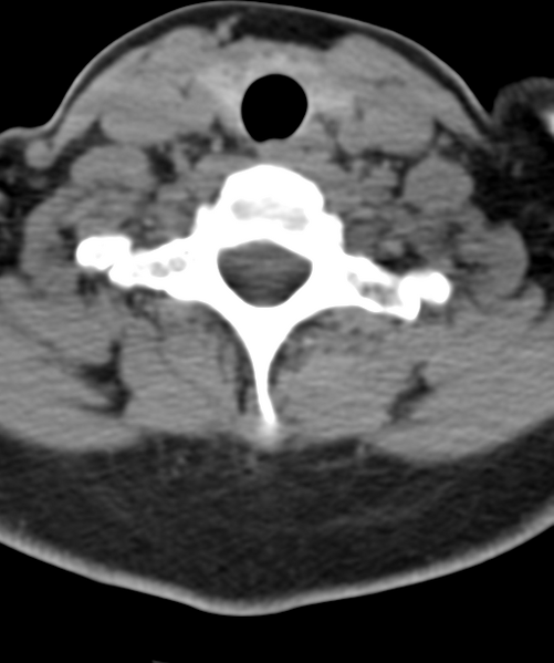 File:Normal cervical spine MRI (including Dixon) (Radiopaedia 42762-45926 Axial non-contrast 47).png