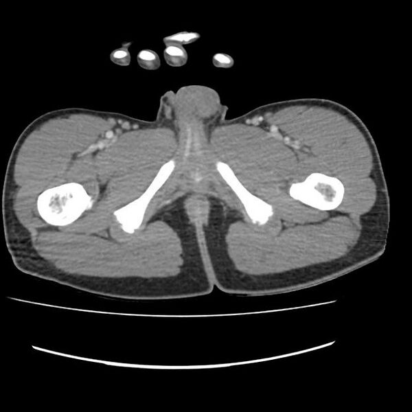 File:Normal dual-phase trauma CT chest,abdomen and pelvis (Radiopaedia 48092-52899 A 121).jpg