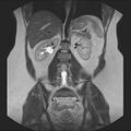 Normal liver MRI with Gadolinium (Radiopaedia 58913-66163 Coronal T2 26).jpg