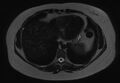 Normal liver MRI with Gadolinium (Radiopaedia 58913-66163 E 29).jpg