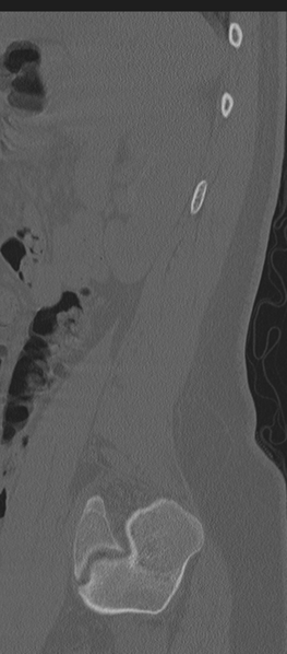 File:Normal lumbosacral CT (Radiopaedia 37923-39867 Sagittal bone window 15).png