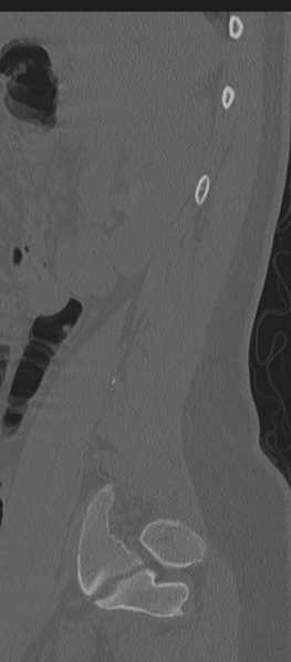 File:Normal lumbosacral CT (Radiopaedia 37923-39867 Sagittal bone window 18).png