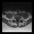 Normal spine MRI (Radiopaedia 77323-89408 Axial T1 22).jpg