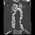 Normal trauma cervical spine (Radiopaedia 41017-43760 Coronal bone window 19).png
