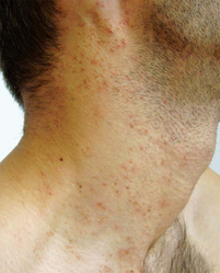 Telangiectasias on the right side of the neck