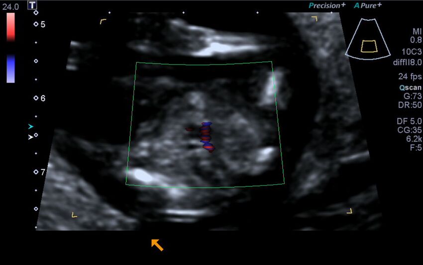 1st trimester nuchal-morphology ultrasound (Radiopaedia 44706-48477 Heart views cine with colour 194).jpg