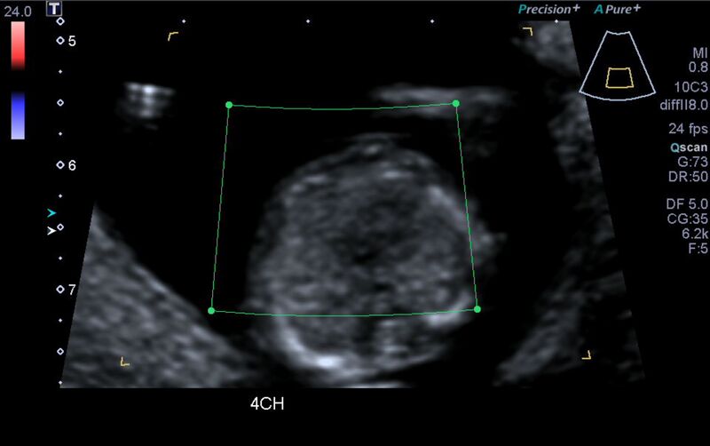 File:1st trimester nuchal-morphology ultrasound (Radiopaedia 44706-48477 Heart views cine with colour 57).jpg