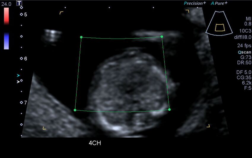 1st trimester nuchal-morphology ultrasound (Radiopaedia 44706-48477 Heart views cine with colour 57).jpg