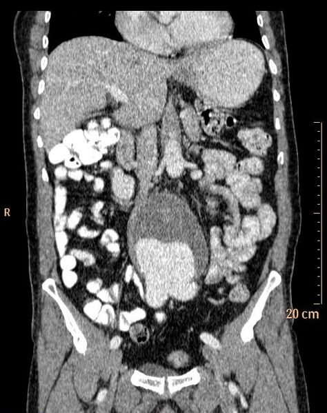 File:Abdominal aortic aneurysm (Radiopaedia 25985-26121 Coronal C+ arterial phase 16).jpg