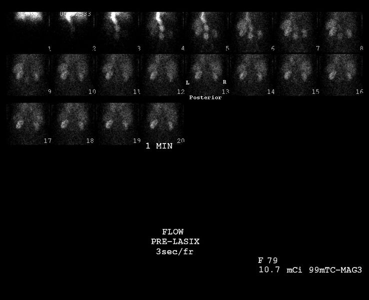 File:Abdominal aortic aneurysm (incidental finding on renal scintigraphy) (Radiopaedia 23997-24195 Perfusion phase . Flow 1).jpg