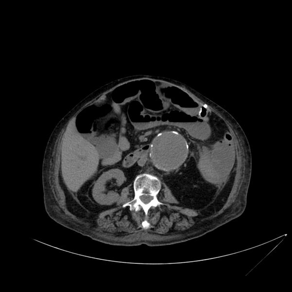 File:Abdominal aortic aneurysm - impending rupture (Radiopaedia 19233-19246 Axial non-contrast 63).jpg